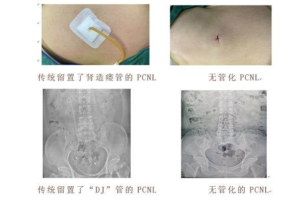 技术再突破——我院成功开展无管化经皮肾镜碎石取石术