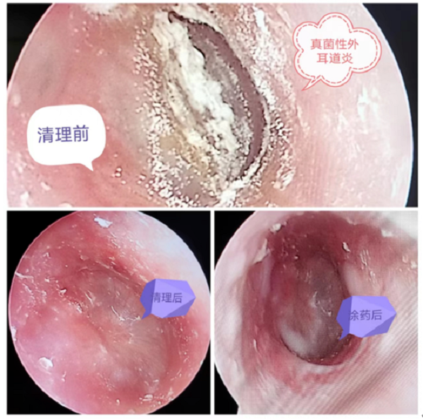 耳朵竟得了“脚气”