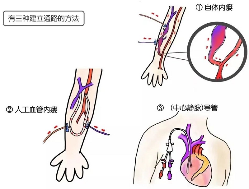 血管通路多(duō)學(xué)科(kē)诊疗模式，守护血透患者“生命線(xiàn)”