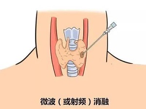 [三比三争] 全县独家！我院成功开展甲状腺微波消融术