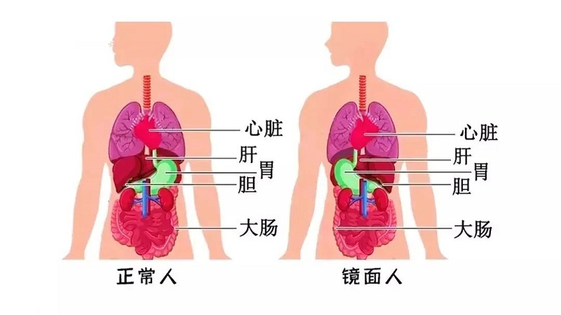 百万分(fēn)之一罕见“镜面人”！五脏六腑反着長(cháng)，手术也得反着来！