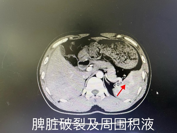 万载县首例——我院肝胆外科(kē)成功自主实施一例高难度全腹腔镜下全脾切除术