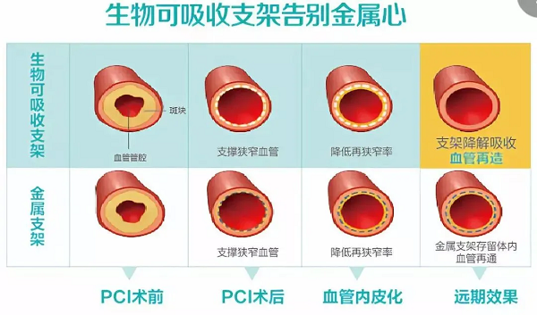 冠心病患者福音！我院成功完成首例可(kě)吸收支架植入！